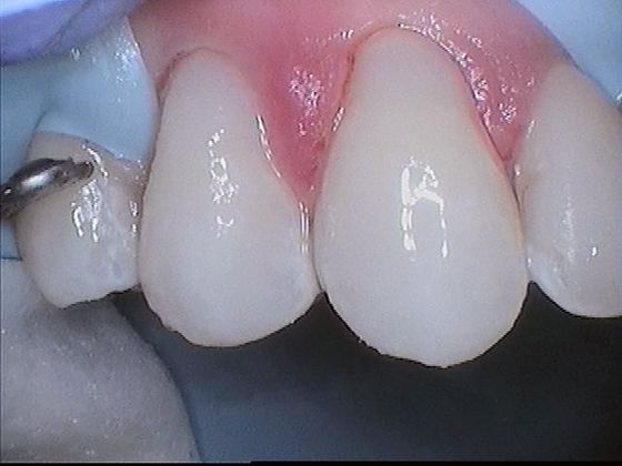Dental Bonding - Teeth Bonding  Case 3 Teeth Bonding Fixes Discolored Front Teeth - After