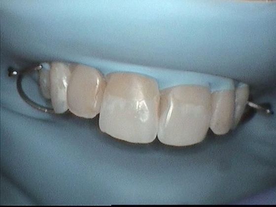 Dental Bonding - Teeth Bonding  Case 4 Cosmetic Bonding for Discolored Front Teeth - Before