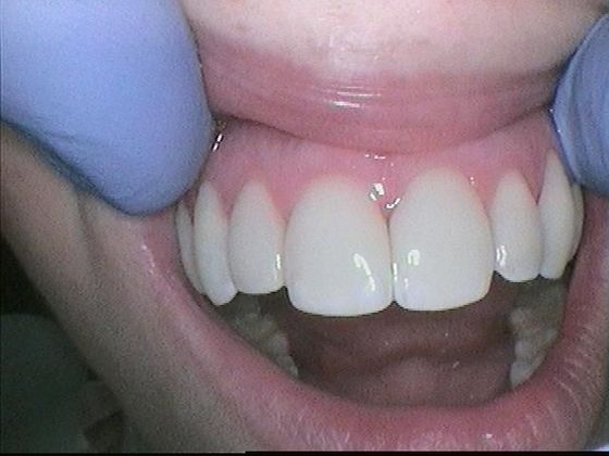 Dental Bonding - Teeth Bonding  Case 4 Cosmetic Bonding for Discolored Front Teeth - After