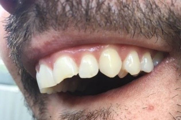 Dental Bonding - Teeth Bonding  Case 5- Broken Tooth Bonded, Dental Accident - Before