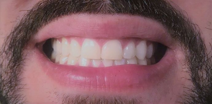 Dental Bonding - Teeth Bonding  Case 5- Broken Tooth Bonded, Dental Accident - After