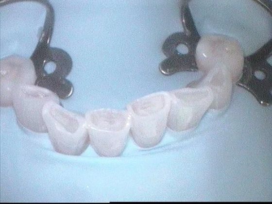 Dental Bonding - Teeth Bonding  Case 6 Front Teeth Worn Down - Before