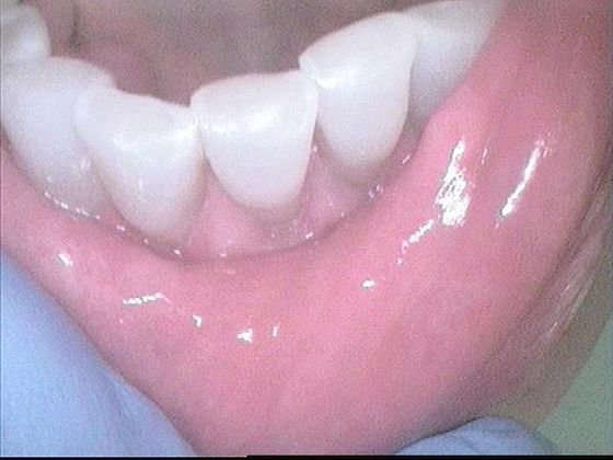 Dental Bonding - Teeth Bonding  Case 6 Front Teeth Worn Down - After