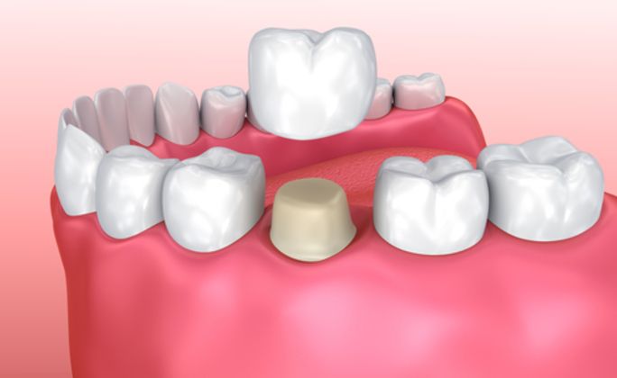 Dental Crowns Cases