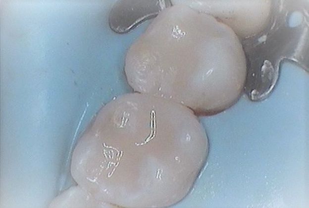 White Fillings: Case 3 Amalgam Filling Replaced with White Composite Filling - After