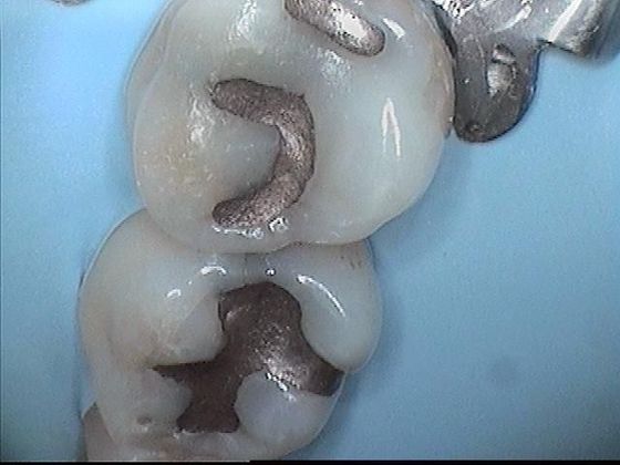 White Fillings: Case 3 Amalgam Filling Replaced with White Composite Filling - Before