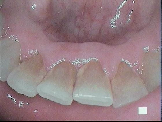 Teeth Cleaning Case 1 Teeth Cleaning - Before