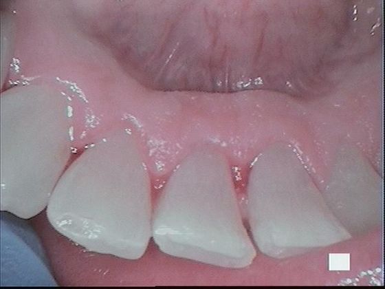 Teeth Cleaning Case 1 Teeth Cleaning - After