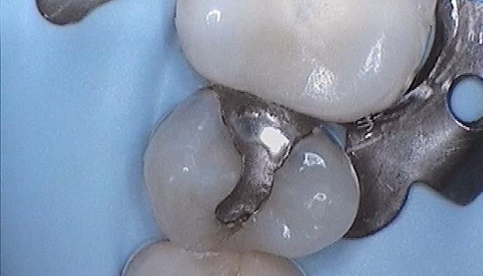 White Fillings Case 4 Tooth Colored Filling Replaces Amalgam Fillings - Before