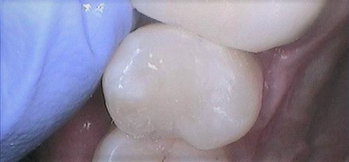 White Fillings Case 4 Tooth Colored Filling Replaces Amalgam Fillings - After
