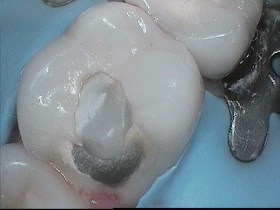 Dental Crowns Case 2 Broken Dental Crown Replaced - Before