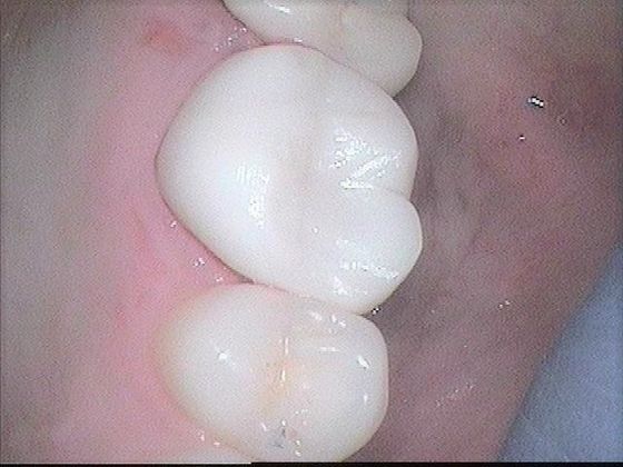 Dental Crowns Case 2 Broken Dental Crown Replaced - After