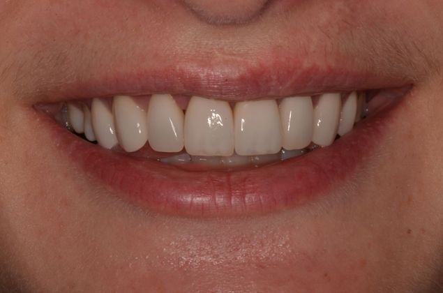 Porcelain Veneers: Case 20 - After