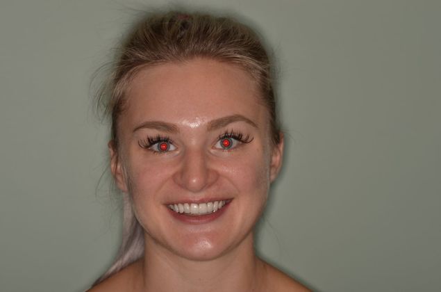 Porcelain Veneers Case 20 - After