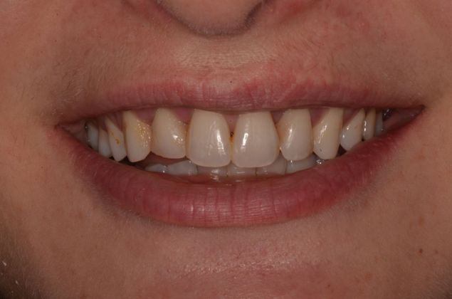 Porcelain Veneers: Case 20 - Before