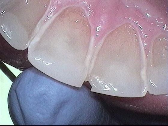 Teeth Cleaning: Case 1 Teeth Cleaning - Before