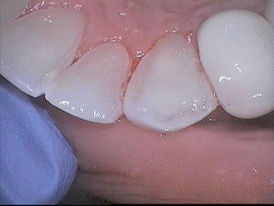 Teeth Cleaning: Case 1 Teeth Cleaning - After