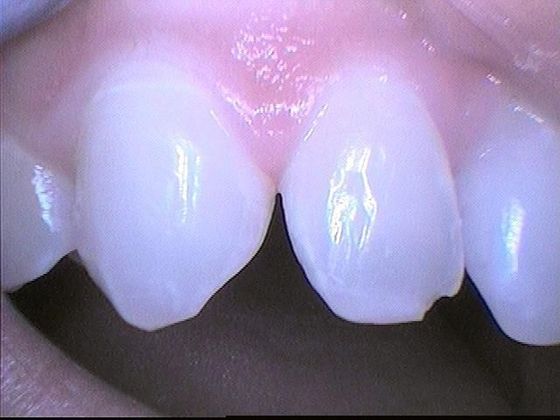 Dental Bonding - Teeth Bonding  Case 7 Chipped Front Tooth - Before