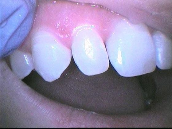 Dental Bonding - Teeth Bonding  Case 7 Chipped Front Tooth - After