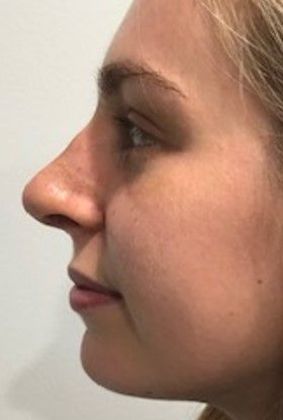 Rhinoplasty: Case 17 - Rhinoplasty Westport - After