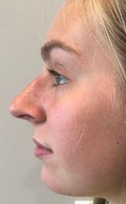 Rhinoplasty: Case 17 - Rhinoplasty Westport - Before