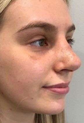 Rhinoplasty: Case 17 - Rhinoplasty Westport - After