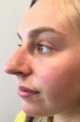 Rhinoplasty: Case 17 - Rhinoplasty Westport - Before