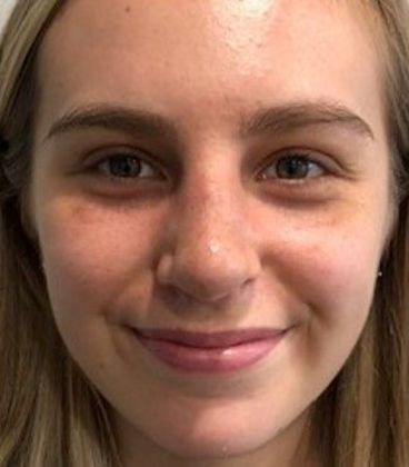 Rhinoplasty: Case 17 - Rhinoplasty Westport - After