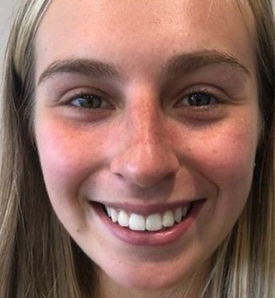 Rhinoplasty: Case 17 - Rhinoplasty Westport - Before