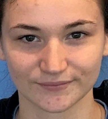 Rhinoplasty: Case 18 Rhinoplasty, Fairfield, CT - Before