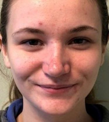 Rhinoplasty: Case 18 Rhinoplasty, Fairfield, CT - After