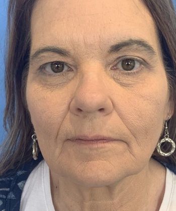 Facelift: Case 22 Facelift, Eyelid Lift New Hartford, CT - Before