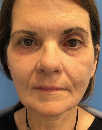 Facelift: Case 22 Facelift, Eyelid Lift New Hartford, CT - After