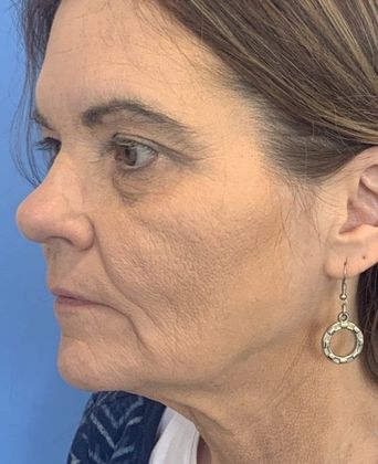 Facelift: Case 22 Facelift, Eyelid Lift New Hartford, CT - Before