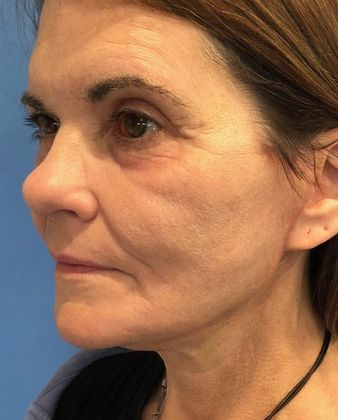 Facelift: Case 22 Facelift, Eyelid Lift New Hartford, CT - After