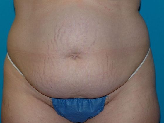 Abdominoplasty Case 3 - Bloomington, IN - Before