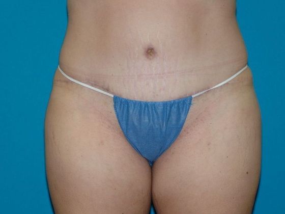 Abdominoplasty Case 3 - Bloomington, IN - After