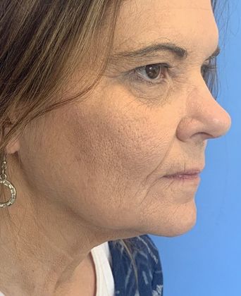 Facelift: Case 22 Facelift, Eyelid Lift New Hartford, CT - Before
