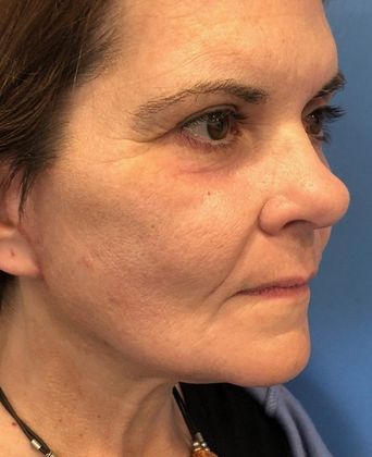 Facelift: Case 22 Facelift, Eyelid Lift New Hartford, CT - After