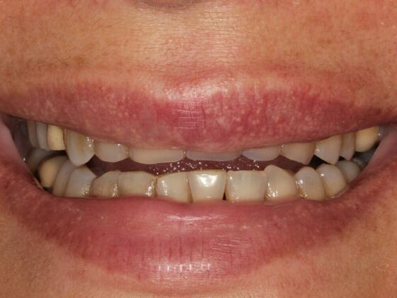 Full Mouth Rehabilitation Case 5 - Before