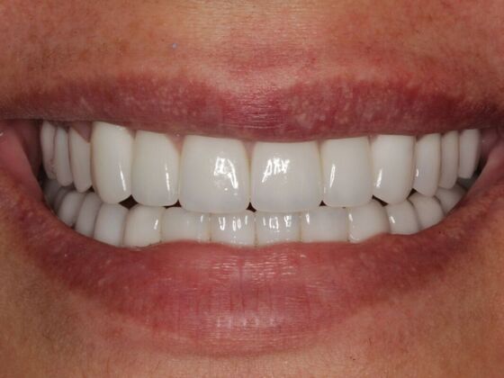 Full Mouth Rehabilitation Case 5 - After