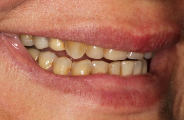 Full Mouth Rehabilitation: Wear and Decay - Before