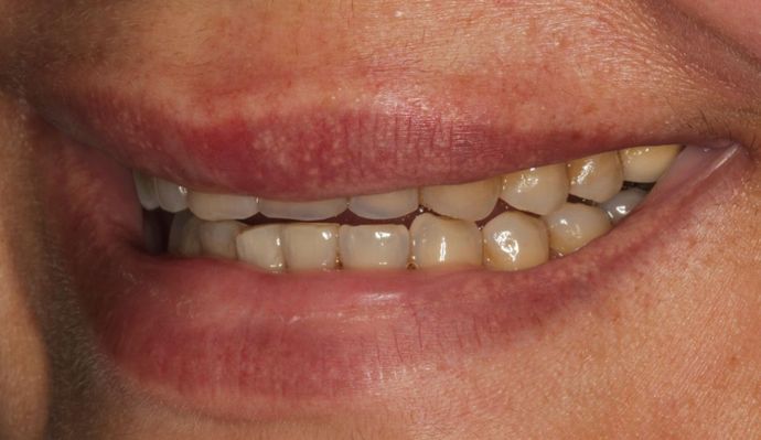 Full Mouth Rehabilitation: Wear and Decay - Before