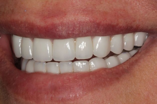 Full Mouth Rehabilitation: Wear and Decay - After