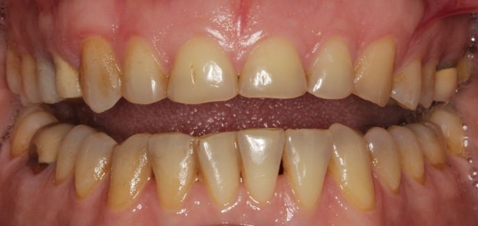 Full Mouth Rehabilitation: Wear and Decay - Before