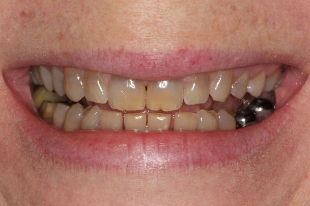 Full Mouth Rehabilitation Full mouth Rehabilitation: Tetracycline Staining, Implants and Broken Teeth - Before