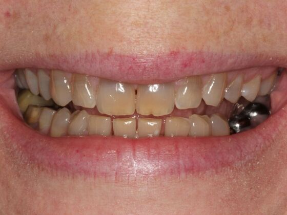 Full Mouth Rehabilitation Case 6 - Before
