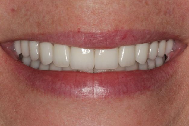 Full Mouth Rehabilitation Full mouth Rehabilitation: Tetracycline Staining, Implants and Broken Teeth - After
