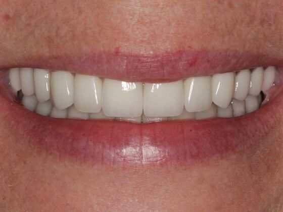 Full Mouth Rehabilitation Case 6 - After