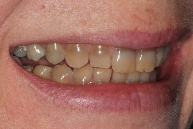 Full Mouth Rehabilitation: Full mouth Rehabilitation: Tetracycline Staining, Implants and Broken Teeth - Before